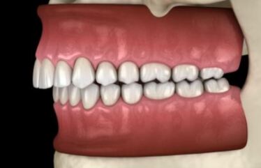 جلو بودن دندان بالا