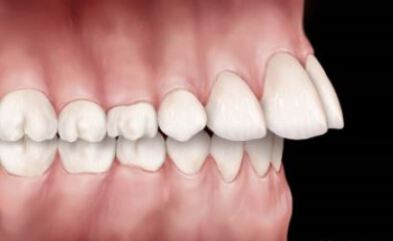 جلو بودن دندان بالا