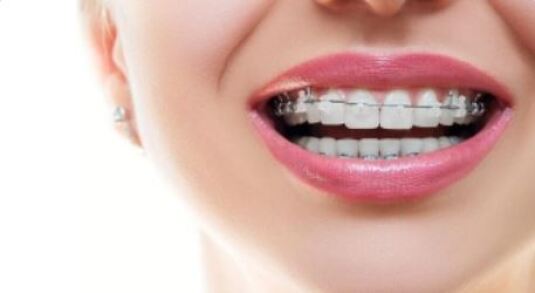 ارتودنسی نامرئی