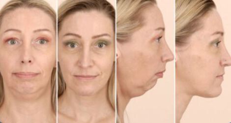 ارتودنسی به همراه جراحی فک