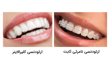 ارتودنسی نامرئی