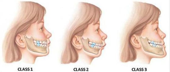 جلو زدگی فک پایین