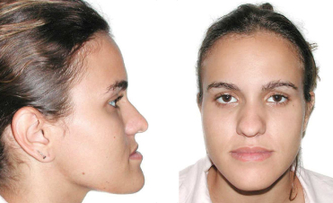 جلو بودن فک با ارتودنسی