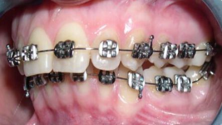 ارتودنسی ثابت تمام فلزی